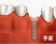 田新歯科インプラント手術